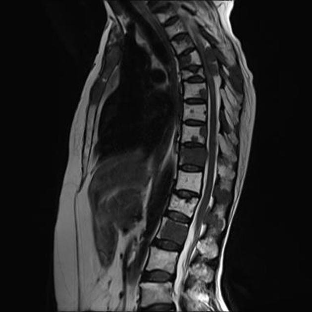 снимок МР-миелография спинного мозга позвоночника